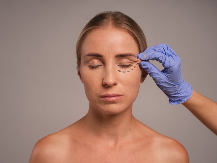 eyelid-surgery-8