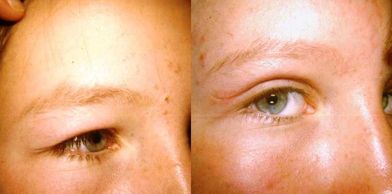 Eyelid Before And After Result