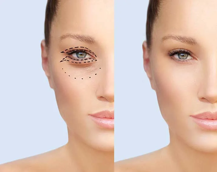 Eyelid Surgery Banner