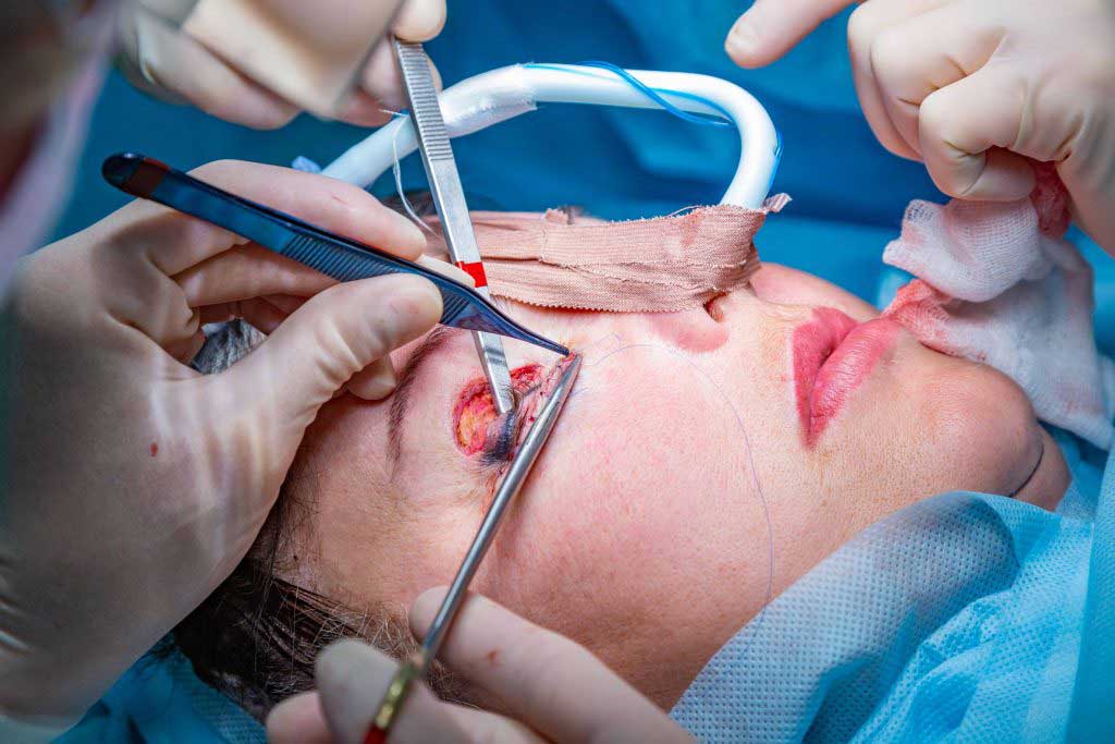 Eyelid Treatment