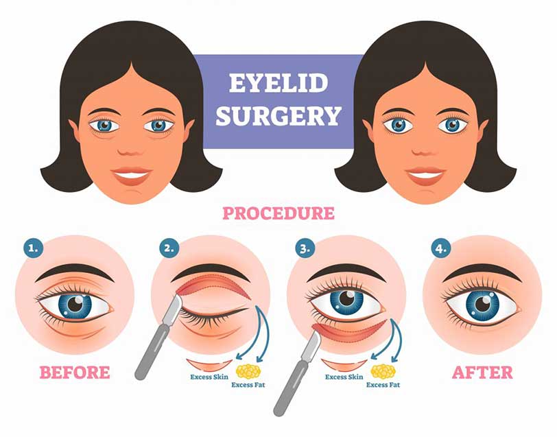 Eyelid Surgery Types